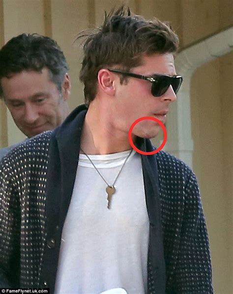 Zac Efron Displays Swollen Face And Large Scar On His Chin After