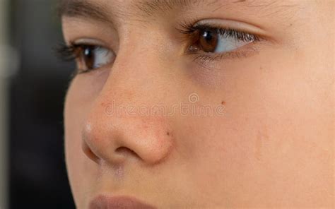 Close Up Blackhead Pimpels On The Nose Of Teenage Boy Skin Care Acne