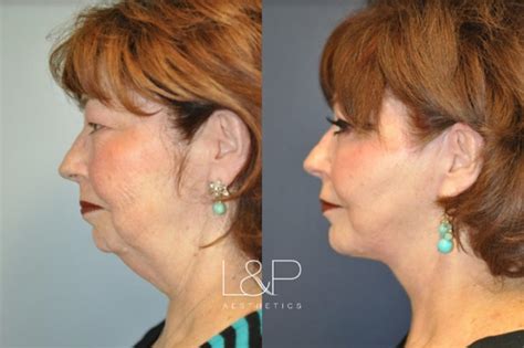 Facelift And Neck Lift Before And After Photos Case 42 Palo Alto And San