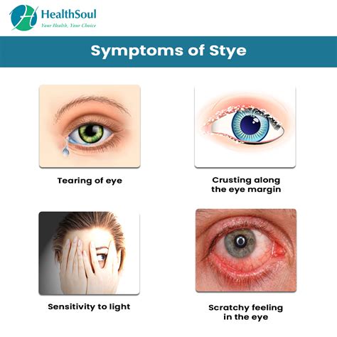 Stye Causes And Treatment Healthsoul
