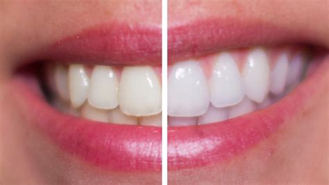 Hydrogen Peroxide Teeth Whitening With Braces Teeth Whitening Kits