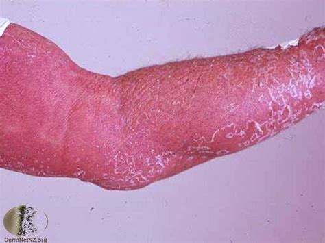 Erythroderma Erythroderma