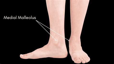 Medial Malleolus Pain Get The Answers From A Foot Specialist