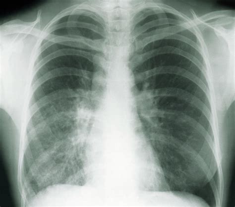 Tuberculosis X Ray Photograph By Simon Fraserscience Photo Library