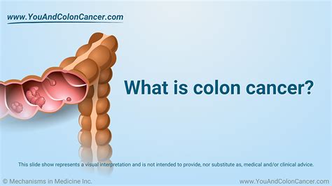 Colon Cancer Visual Updating Colorectal Cancer Screening Guidelines