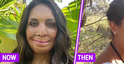 The Remarkable Story Of Turia Pitt Who Survived A Deadly Fire And