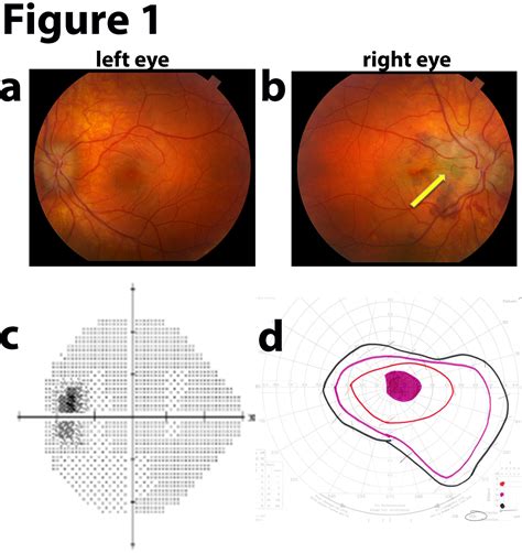 Moran Core Photographic Essay Of Idiopathic Intracranial Hypertension