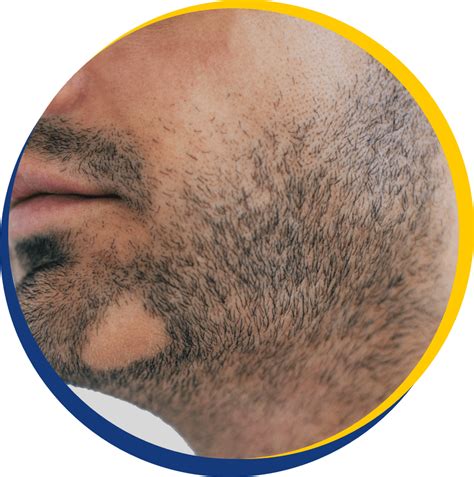 Facial Hair Beard Loss The Knudsen Clinic