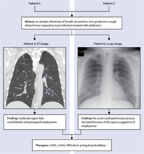 CT Imaging Of Chronic Obstructive Pulmonary Disease Insights Disappointments And Promise