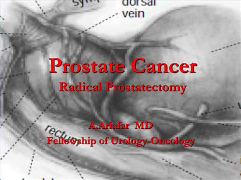 Ppt Prostate Cancer Radical Prostatectomy Powerpoint Presentation Free Download Id