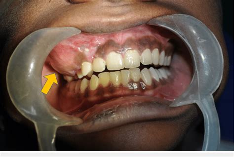 Intraoral View Showing The Swelling Obliterating The Upper Right Buccal