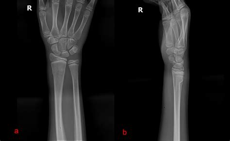 A Painful Wrist After A Fall The Bmj