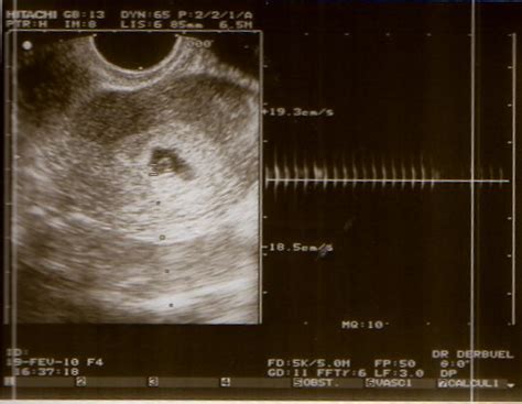 Après seulement 3 semaines de grossesse, le cœur est un groupe de cellules musculaires léthargiques et minuscules, mais qui 22 jours plus tard votre poids ne changera pas beaucoup, vous ne prendrez qu'un ou deux grammes à la 3ème semaine de grossesse à cause de la légère. ECHO J25 ou 4eme semaine - Caroline et Alban ...