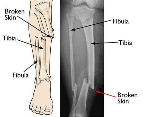 Infections After Fracture Causes And Treatment Orthoinfo Aaos