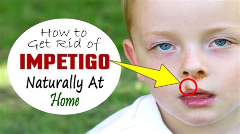 How To Get Rid Of Impetigo Home Remedies For Impetigo Treatment