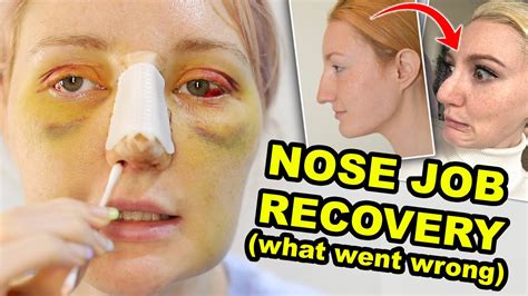 My Nose Job Part 2 What Went Wrong And Why I Regret It Youtube