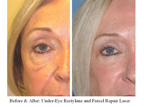 Treatment Of Loose Under Eye Skin Hollowness And Bags With