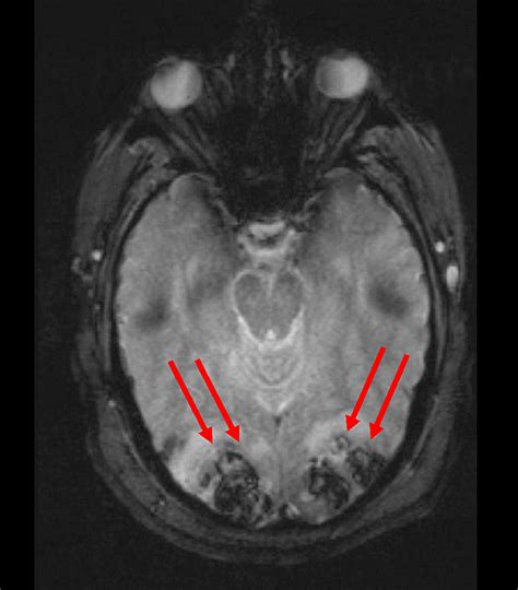 Cureus Bilateral Occipital Lobe Hemorrhages Presenting As Denial Of