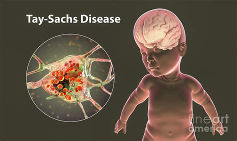 Tay Sachs Disease Photograph By Kateryna Kon Science Photo Library Pixels