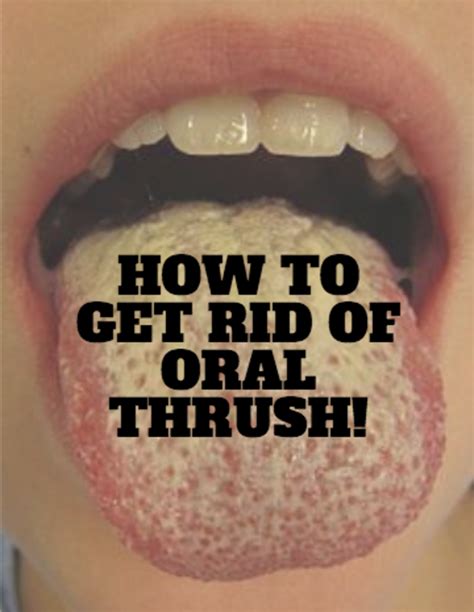 9 Methods For How To Battle Oral Thrush Remedygrove