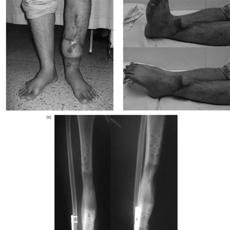 A And B The Clinical Results Of Flap Coverage The Distal Tibia And