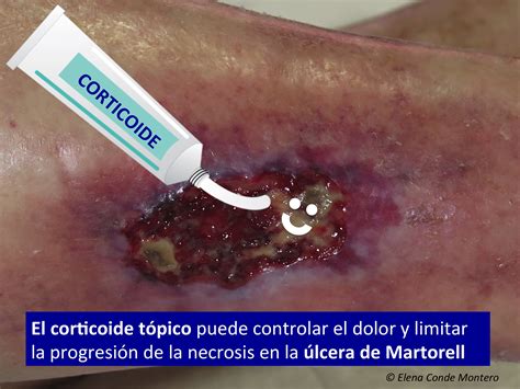 Maybe you would like to learn more about one of these? El interés del corticoide tópico en la úlcera de Martorell ...