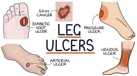 Diabetic Foot Ulcers Vs Venous Or Arterial Ulcers Posters My XXX Hot Girl