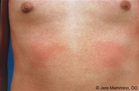 Scarlet Fever American Osteopathic College Of Dermatology Aocd