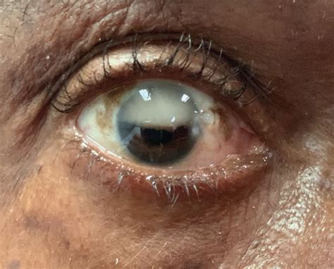 Eye After Vitrectomy