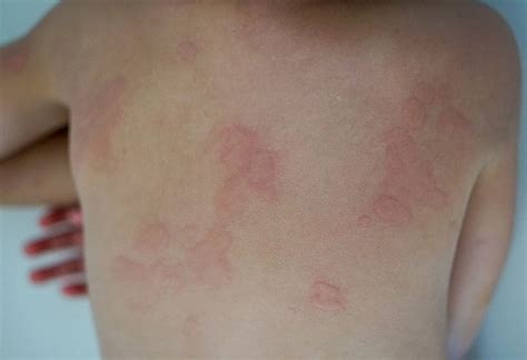 How Deal With Papular Urticaria In Kids