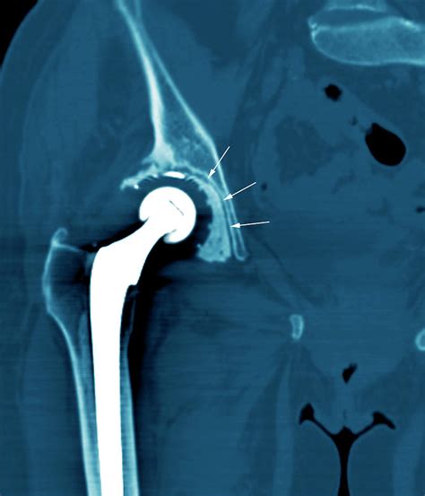 Loosened Hip Replacement Photograph By Zephyrscience Photo Library