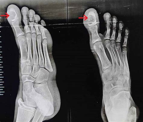 Cureus Chondromyxoid Fibroma Of Distal Phalanx Of The Great Toe A