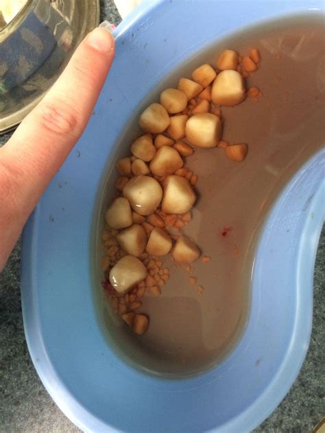 Bladder stones in dogs are also known as urinary calculi and the condition is referred to as urolithiasis. all of the bladder stones my vet removed from my poor dog ...