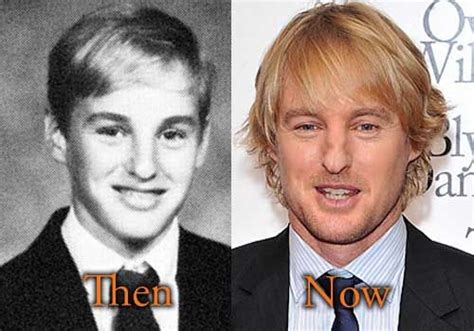 Owen Wilson Plastic Surgery Broken Nose Before After Picture Plastic