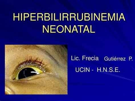 Ppt Hiperbilirrubinemia Neonatal Powerpoint Presentation Free