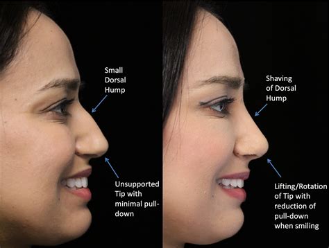 What Is Closed Rhinoplasty Closed Rhinoplasty For Bulbous Nose Tip