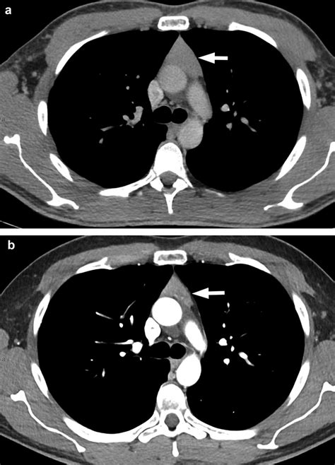 A Contrast Enhanced Ct Of The Chest At The Time Of Presentation