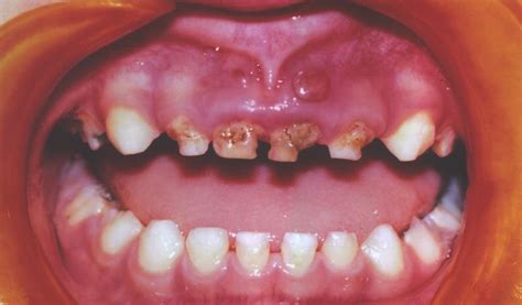 Early Childhood Caries Ecc — Etiology Clinical Consequences And