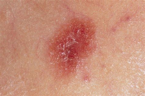 Types Of Melanoma Skin Cancer