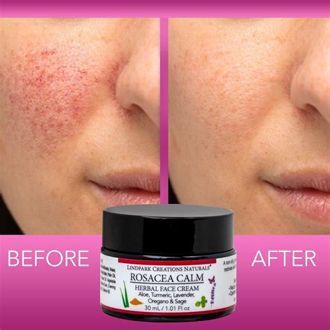rosacea calm face treatment cream skin specialist naturopath dermatology conditions