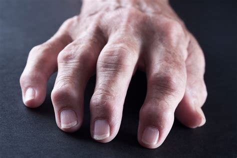 ¿es Lo Mismo La Artrosis Que La Artritis Bekia Salud