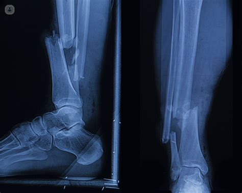Top 134 Fractured Heel Recovery Time Jtcvietnam Edu Vn