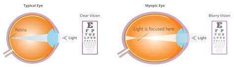 Myopia Graphics Fairlawn Eye Care
