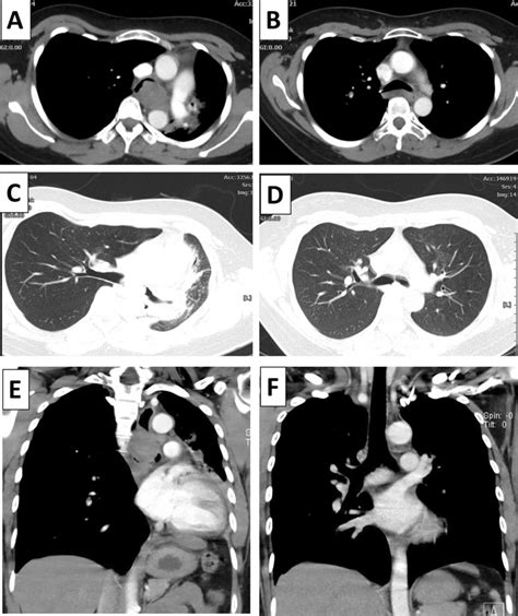 Thoracic Computed Tomography Ct Scan Before And After Treatment A