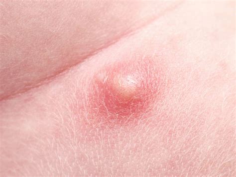Pimple On Scrotum Causes Types And When To See A Doctor Health