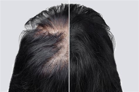 Understanding The Different Types Of Hair Loss Ds Healthcare Group