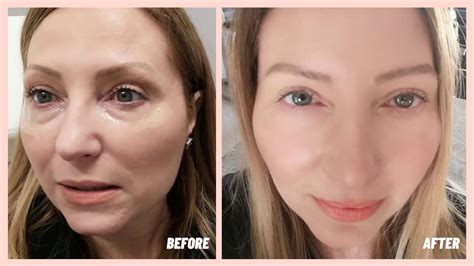 Under Eye Filler Before And After My Experience Youtube
