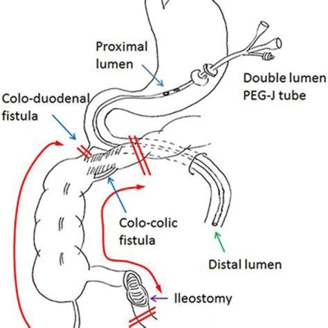 Schema Showing The Gastro Jejunostomy Tube The Location Of Two