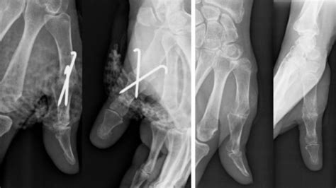 Osteoarthritis Of The Fingers Hand Surgeryeu
