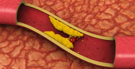 When that happens, symptoms usually come on more gradually, but can. What causes blood clots in legs and how to prevent and treat.